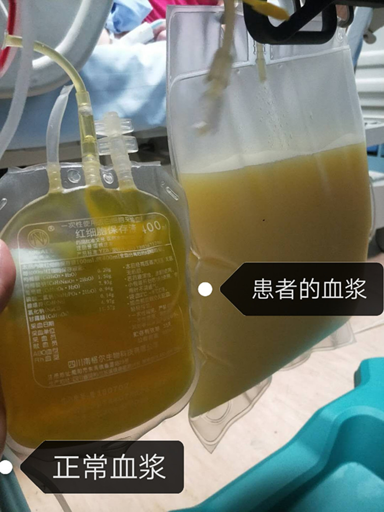 看，這血黏成這樣血濾器都被血脂堵死了--漳州市中醫(yī)院ICU重癥胰腺炎救治成功記