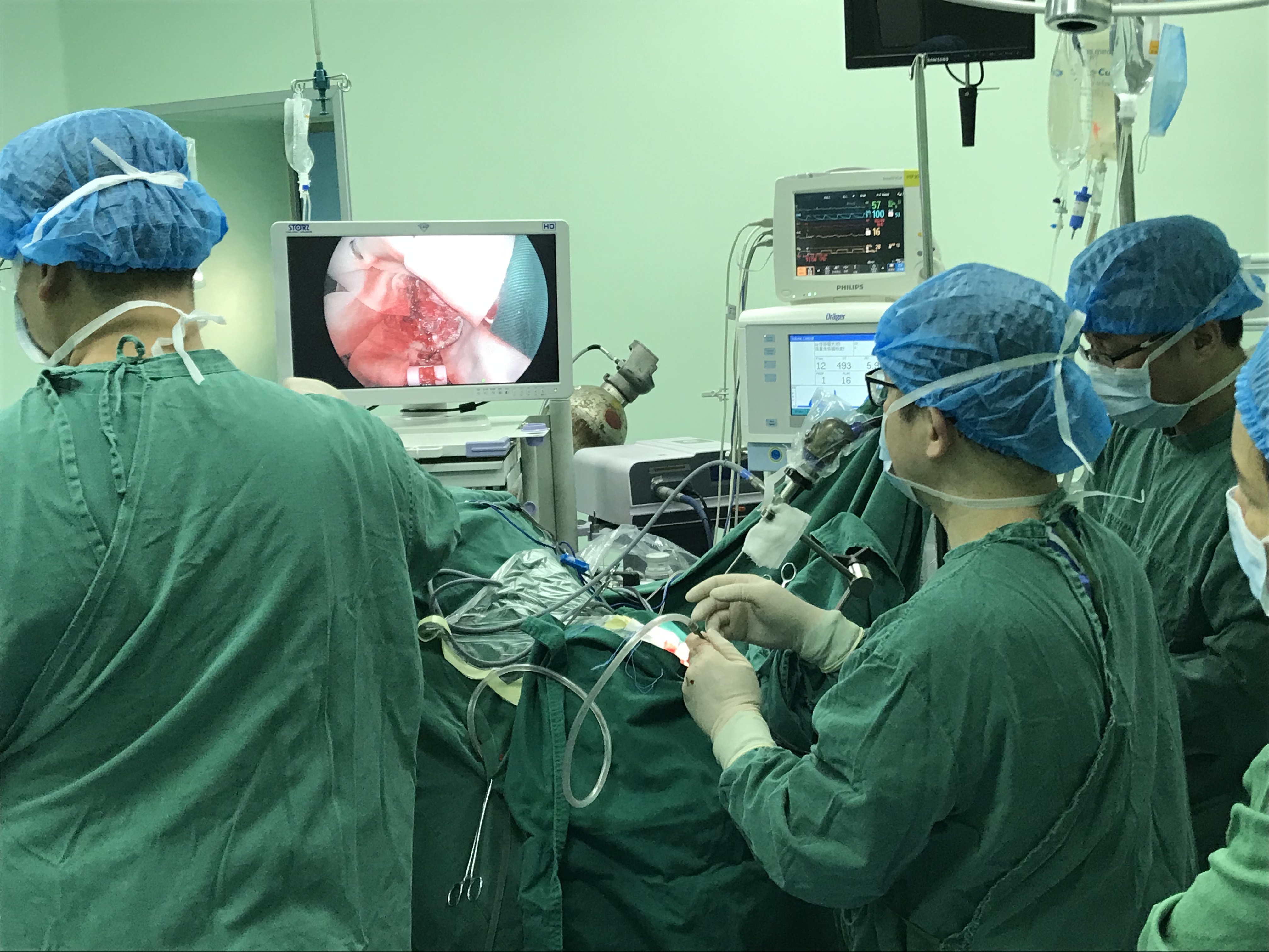 漳州市中醫(yī)院神經(jīng)外科成功完成一例 神經(jīng)內(nèi)鏡下鐮旁腦膜瘤切除術(shù)