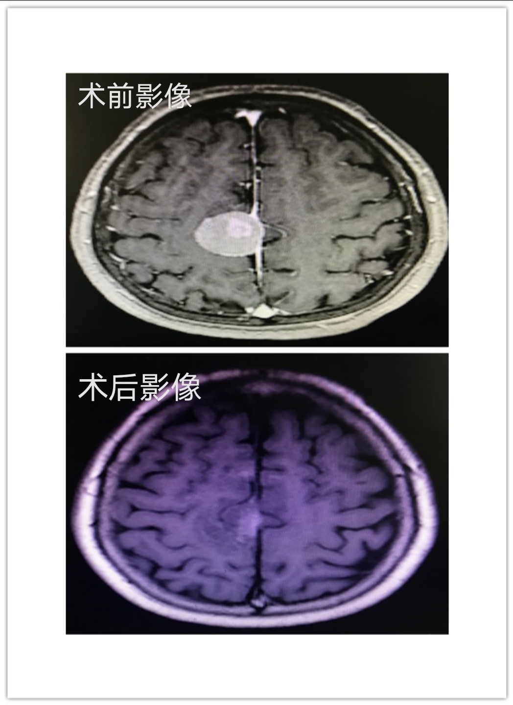 漳州市中醫(yī)院神經(jīng)外科成功完成一例 神經(jīng)內(nèi)鏡下鐮旁腦膜瘤切除術(shù)