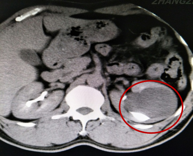 贊！不用開刀就能把腎臟內(nèi)8公分大的囊腫取出來