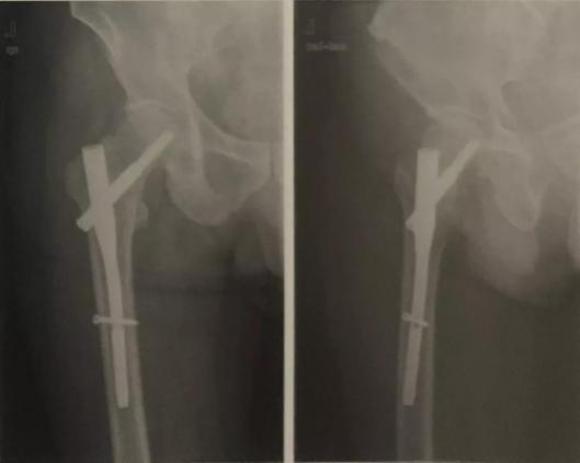 骨折了，醫(yī)生為什么不馬上給我動手術(shù)？