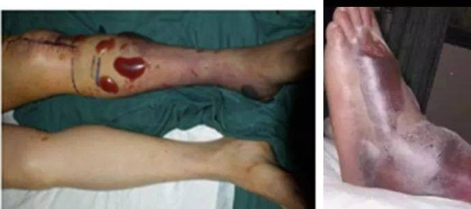 骨折了，醫(yī)生為什么不馬上給我動手術(shù)？