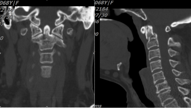 突破手術(shù)“禁區(qū)”成功實(shí)施頸寰樞椎內(nèi)固定手術(shù)