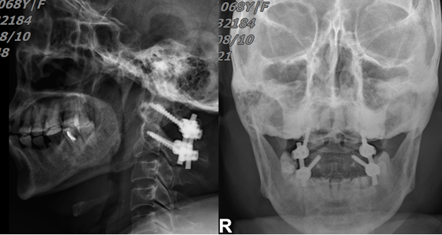 突破手術(shù)“禁區(qū)”成功實(shí)施頸寰樞椎內(nèi)固定手術(shù)