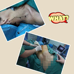 精準(zhǔn)麻醉助力肩胛骨骨折內(nèi)固定術(shù)順利實施