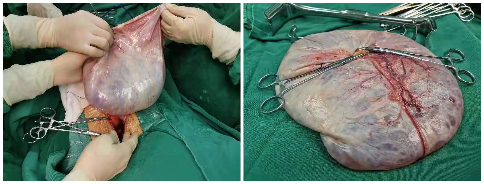 漳州市中醫(yī)院妙手摘除百歲老人巨大卵巢囊腫