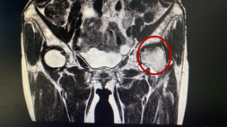 “不死癌癥”股骨頭壞死患者治療新希望
