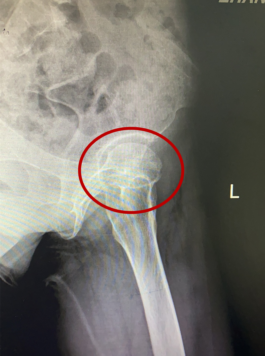 “不死癌癥”股骨頭壞死患者治療新希望