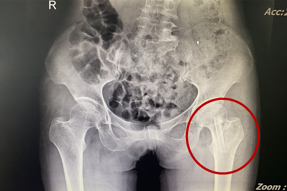 “不死癌癥”股骨頭壞死患者治療新希望