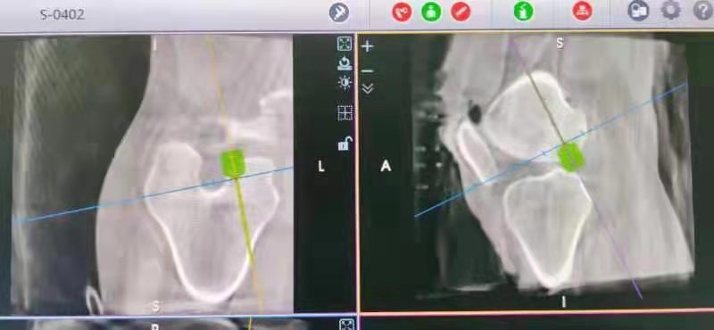 首例機(jī)器人輔助前交叉韌帶重建術(shù)在我院成功實(shí)施