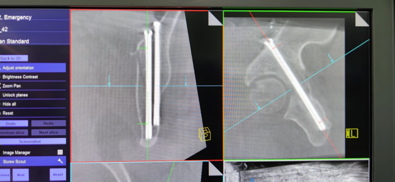手術(shù)機(jī)器人再顯神通  救治髖臼骨折患者