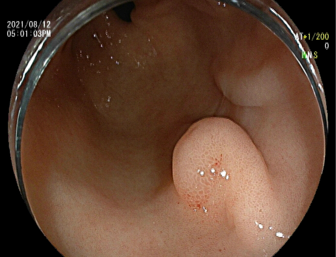 小小內鏡顯神通  中西結合瘥頑疾