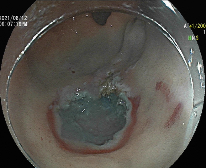 小小內鏡顯神通  中西結合瘥頑疾
