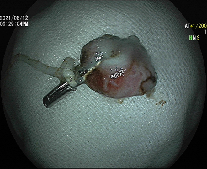 小小內鏡顯神通  中西結合瘥頑疾