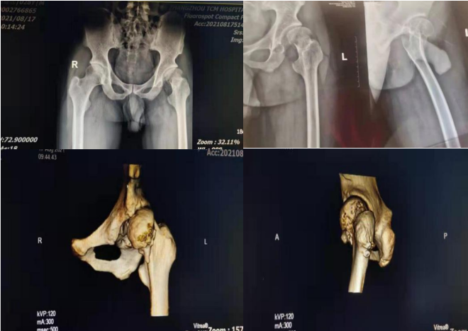 骨科機(jī)器人|精準(zhǔn)“導(dǎo)航”告別“暗箱操作”