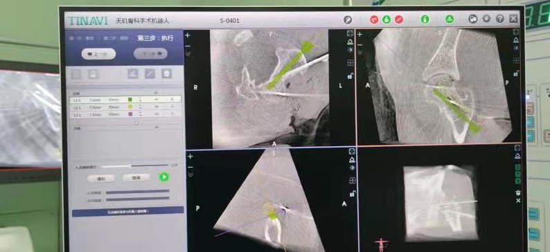 骨科機(jī)器人|精準(zhǔn)“導(dǎo)航”告別“暗箱操作”