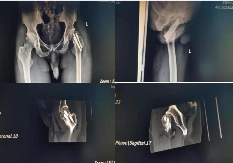 骨科機(jī)器人|精準(zhǔn)“導(dǎo)航”告別“暗箱操作”