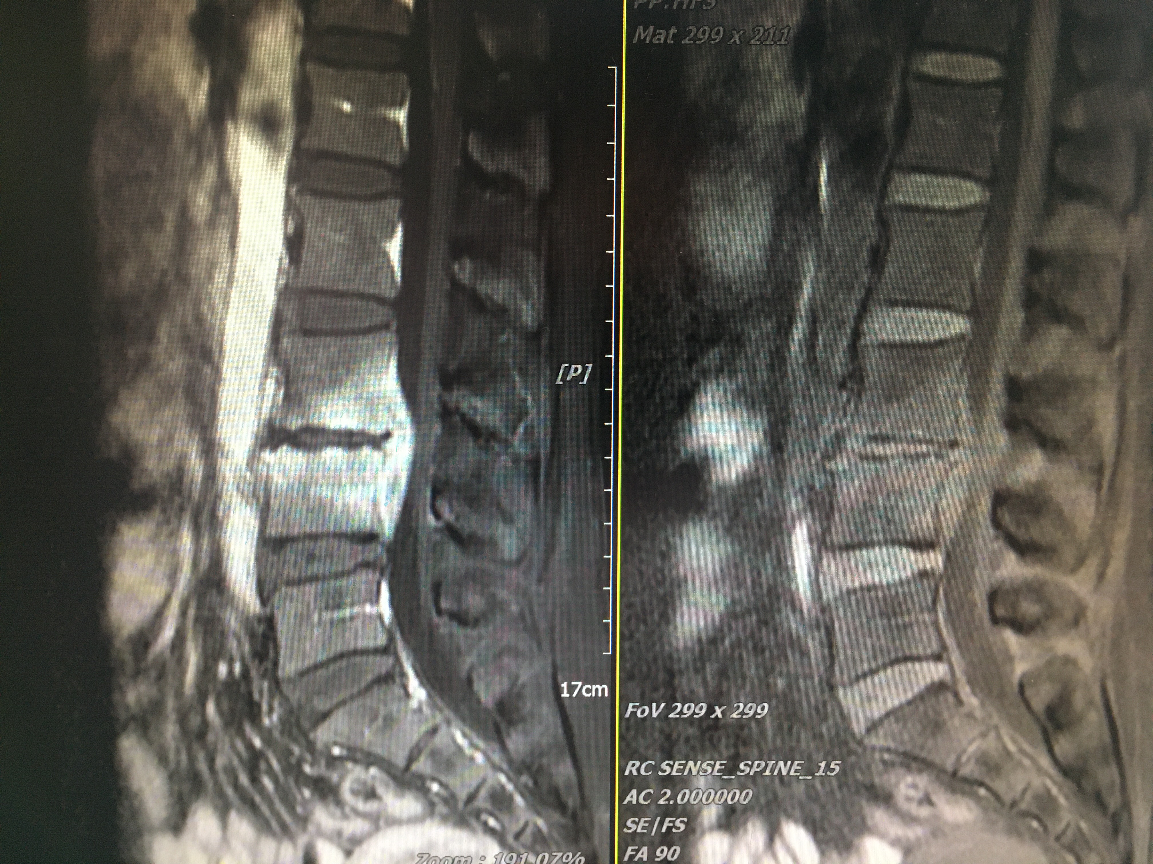 Olif手術(shù)入路+天璣骨科機(jī)器人治療化膿性脊柱炎