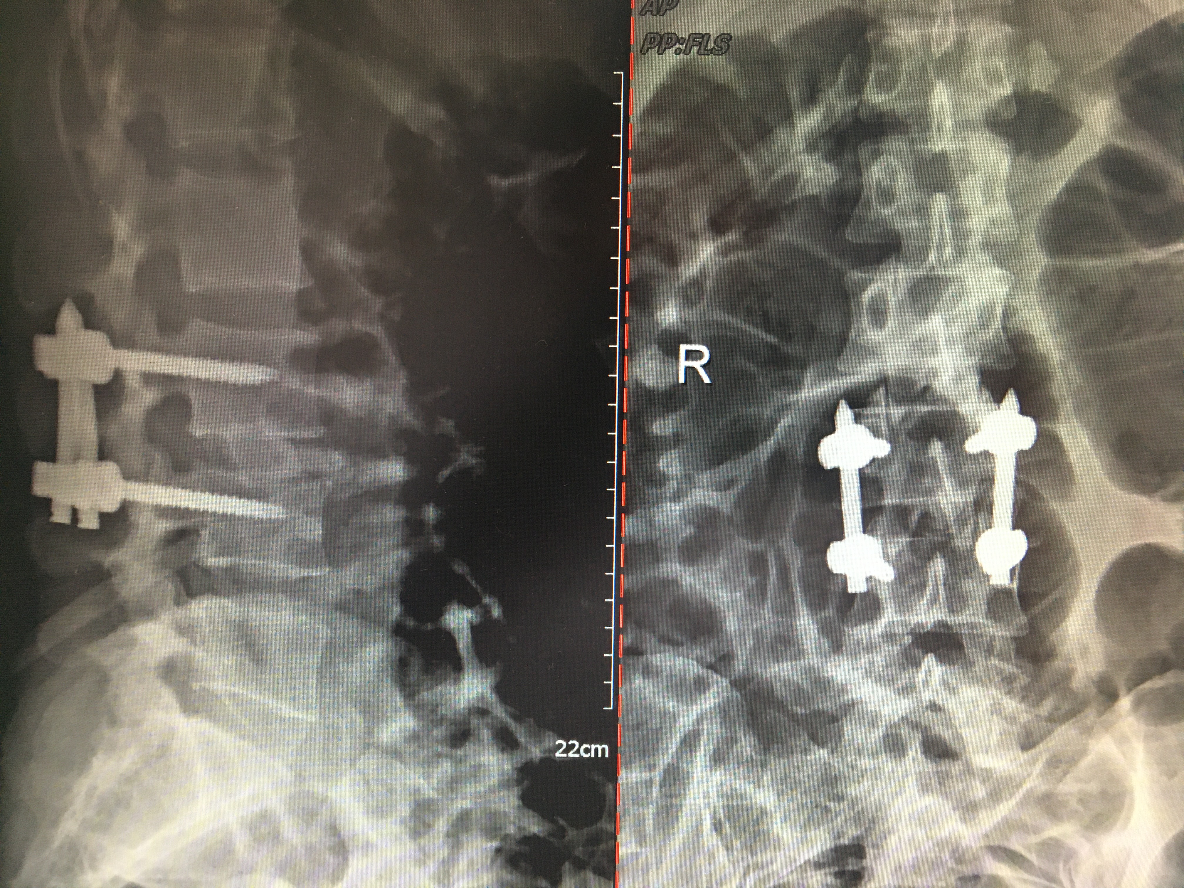 Olif手術(shù)入路+天璣骨科機(jī)器人治療化膿性脊柱炎