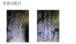漳州市中醫(yī)院率先在漳州成功開展UBE(單邊雙通道內(nèi)鏡技術(shù))微創(chuàng)手術(shù)