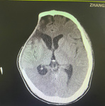 技術(shù)革新 |我院神經(jīng)外科完成多例聚醚醚酮（PEEK）材料顱骨修補(bǔ)術(shù)