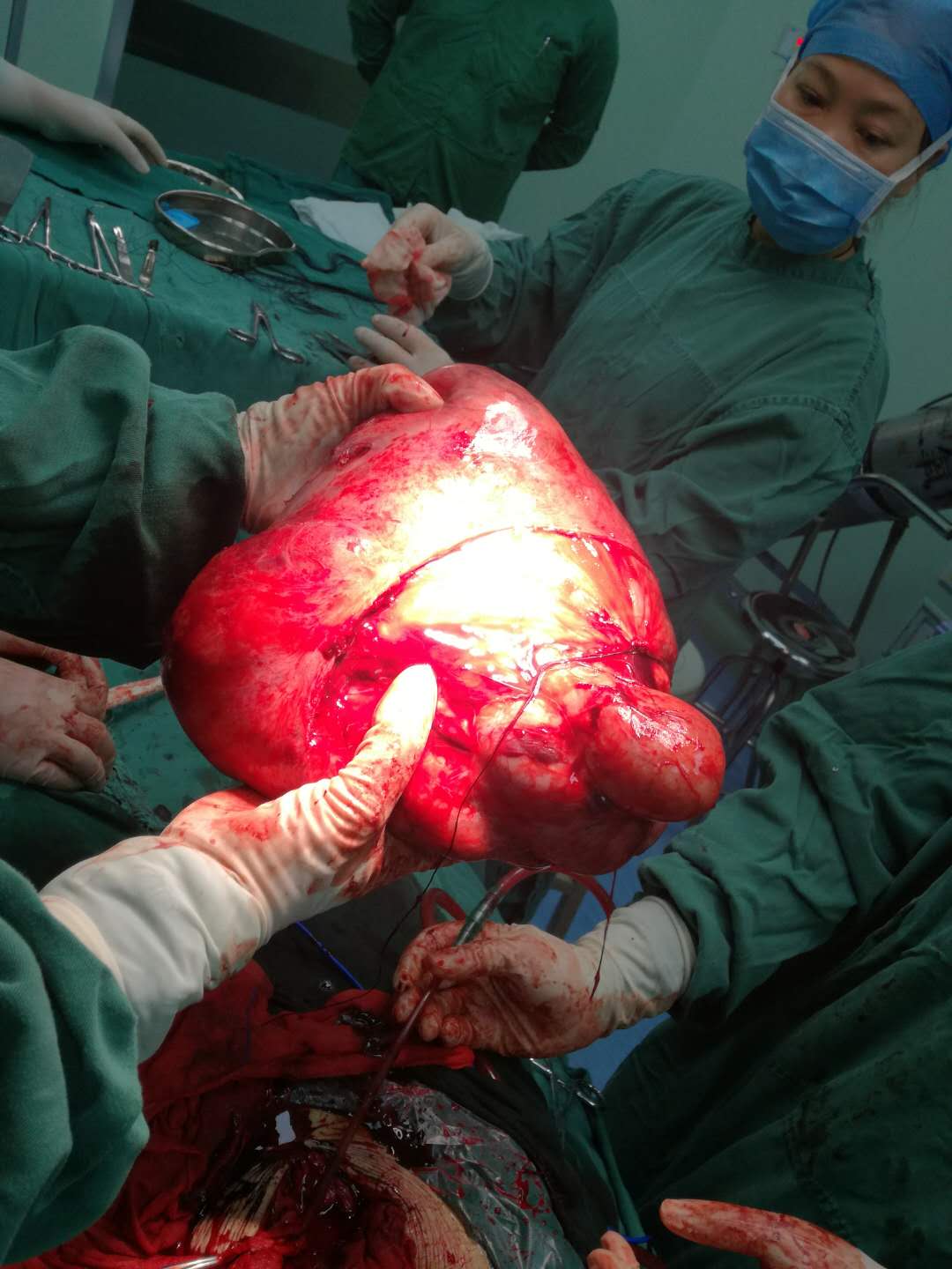 7.6斤瘤子作怪 肚子大如孕婦——我院婦產(chǎn)科成功切除盆腔巨大腫瘤
