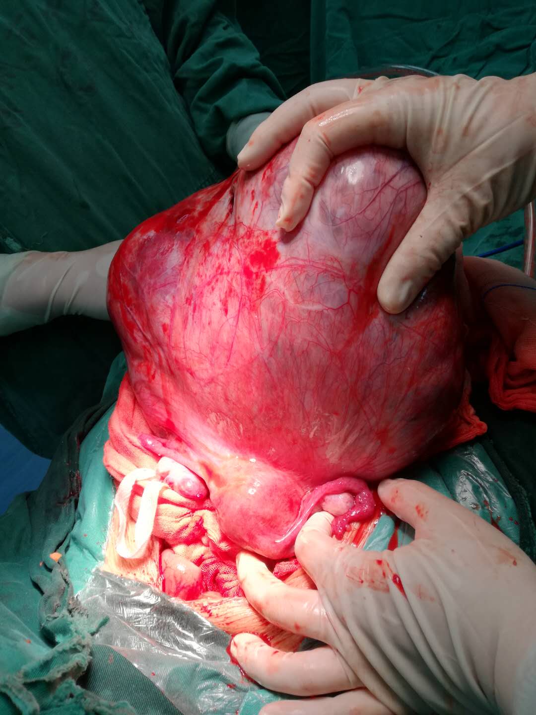 7.6斤瘤子作怪 肚子大如孕婦——我院婦產(chǎn)科成功切除盆腔巨大腫瘤